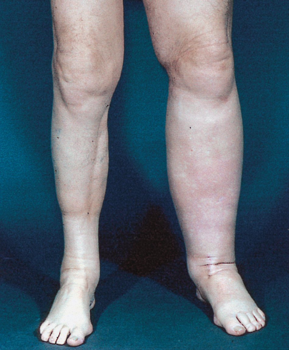 The Multiple Causes Of Swollen Legs – DrStaicu.com