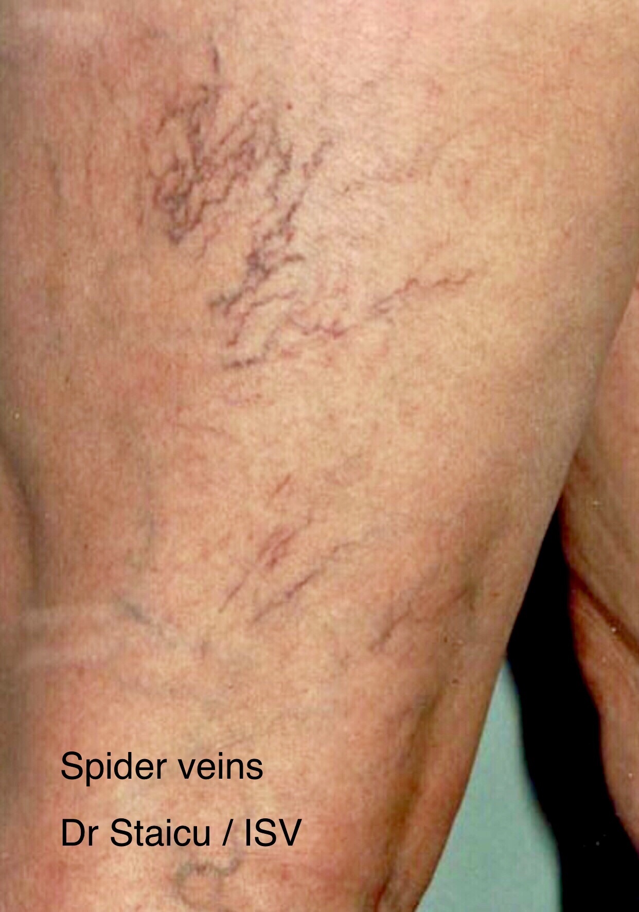 Where Is The Line Between Cosmetic And Medical Varicose Vein Disease ...